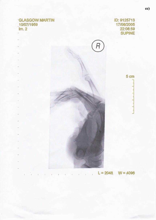 cc) X-Ray of Right Hand Taken on the 17th August 2005
